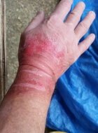 Burned hand picture one