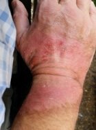 Burned hand picture two