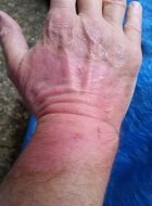 Burned hand picture three