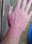 Burned hand picture four